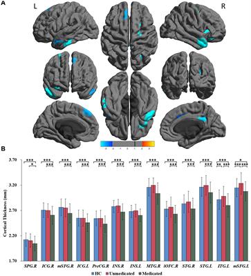 Antipsychotic Effects on Cortical Morphology in Schizophrenia and Bipolar Disorders